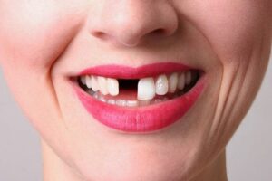 Penyebab Gigi Copot dan Bagaimana Cara Mengatasinya